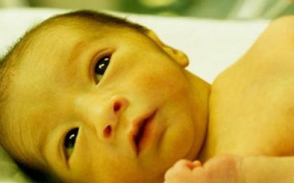 Vàng da xuất hiện trên toàn cơ thể trẻ cho thấy Bilirubin đang ở mức cao, nguy cơ gây nguy hiểm cho trẻ