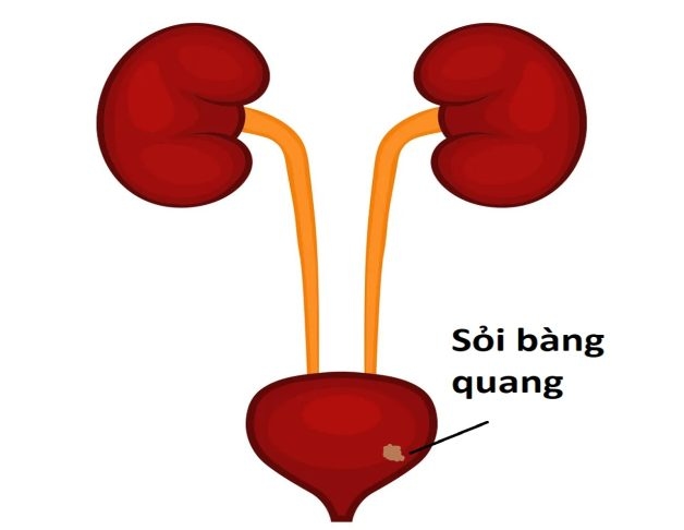 Triệu chứng đau sỏi bàng quang và cách giải quyết