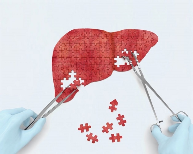 phát hiện và điều trị xơ gan
