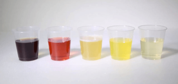 tán sỏi nội soi niệu quản