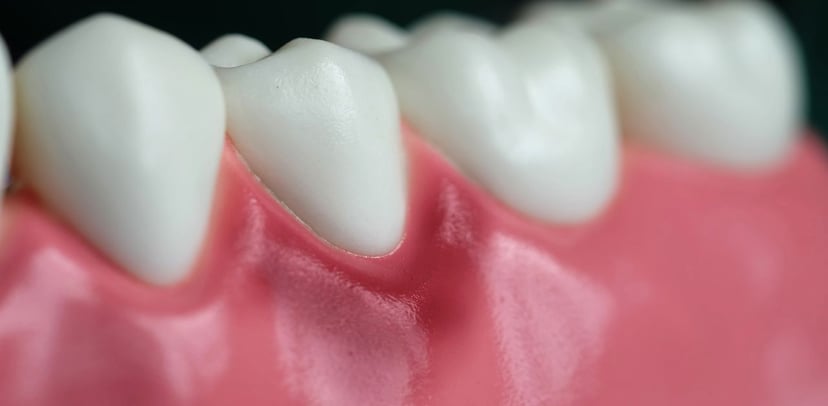 Dấu hiệu bệnh viêm chân răng ở trẻ em