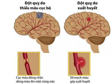 Đột quỵ từ cơn đau đầu vận mạch (đau nửa đầu)