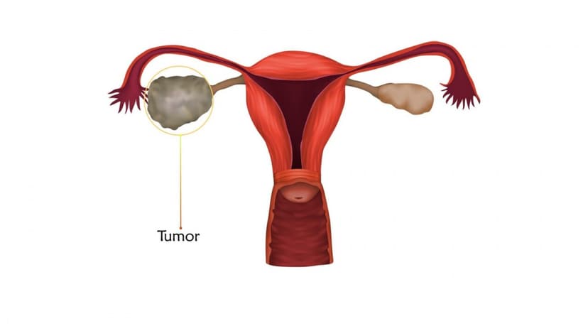 Dấu hiệu ung thư buồng trứng và cách điều trị
