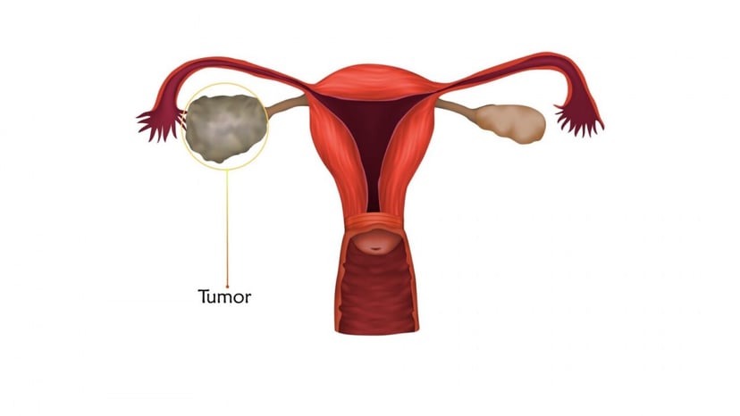 Dấu hiệu ung thư buồng trứng và cách điều trị