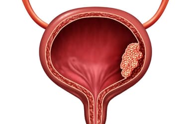 Hóa trị ung thư bàng quang – những điều cần biết