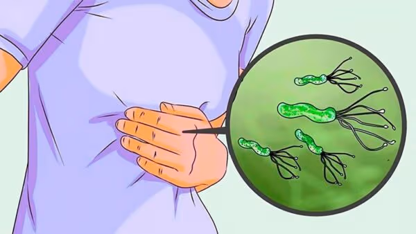 Nguyên tắc trong điều trị vi khuẩn HP