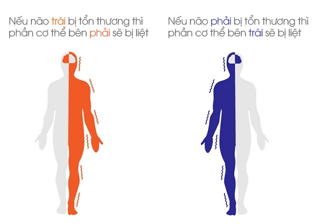 các biểu hiện của tai biến mạch máu não - Một phần của cơ thể bị yếu đi, không thể cử động