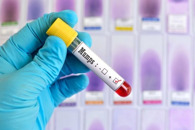 Bệnh truyền nhiễm cấp tính quai bị được xác định là phát sinh do virus Mumps, thuộc chi Rubulavirus, họ Paramyxoviridae.