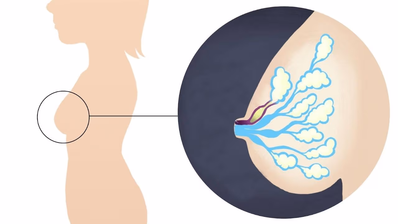 Tắc tia sữa là tình trạng hệ thống ống dẫn sữa bị tắc, do đó sữa không thể chảy ra ngoài được
