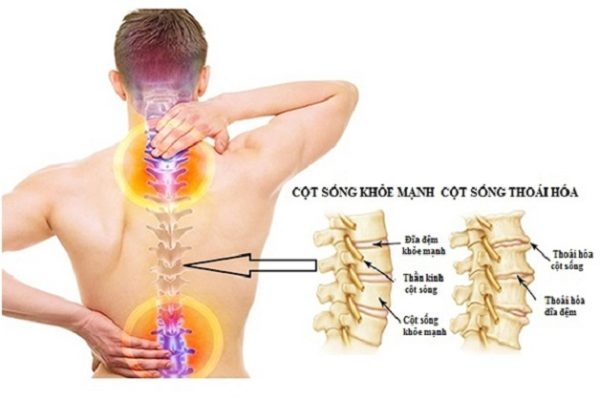 Thoái hóa đốt sống cổ chèn dây thần kinh làm bệnh nhân đau đầu, đau vai