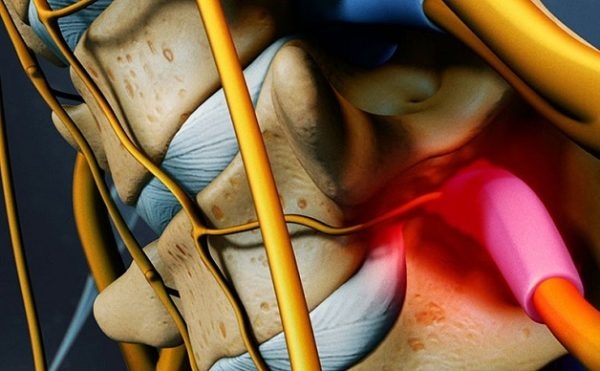Thoái hóa đốt sống cổ chèn dây thần kinh khiến người bệnh đau đớn, mệt mỏi
