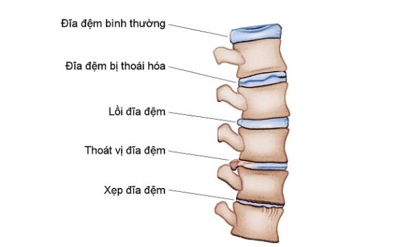 Thoái hóa cột sống thắt lưng ảnh hưởng đến đi lại, sinh hoạt của bệnh nhân