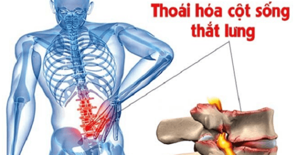 Thoái hóa cột sống thắt lưng có nguy hiểm không?