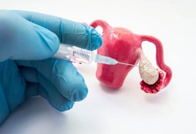 U nang hoàng thể có phải dạng u nang buồng trứng đáng lo ngại?