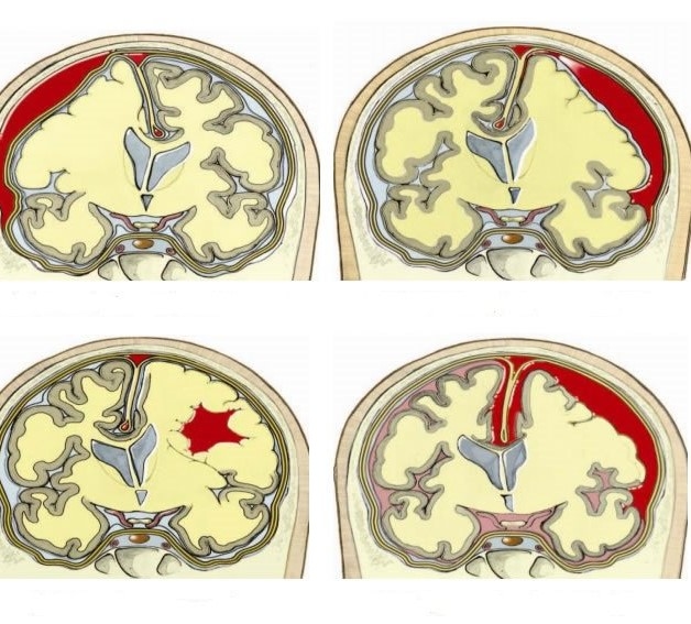 Chấn thương sọ não cũng là 1 trong những tác động dẫn đến động kinh
