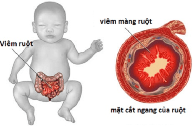 Bệnh viêm ruột hoại tử ở trẻ em