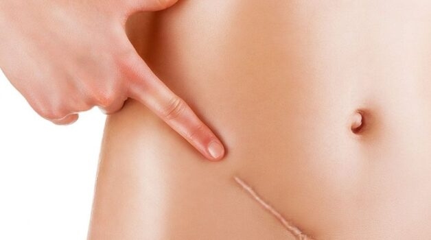 Phẫu thuật viêm ruột thừa là phương pháp phổ biến hiện nay