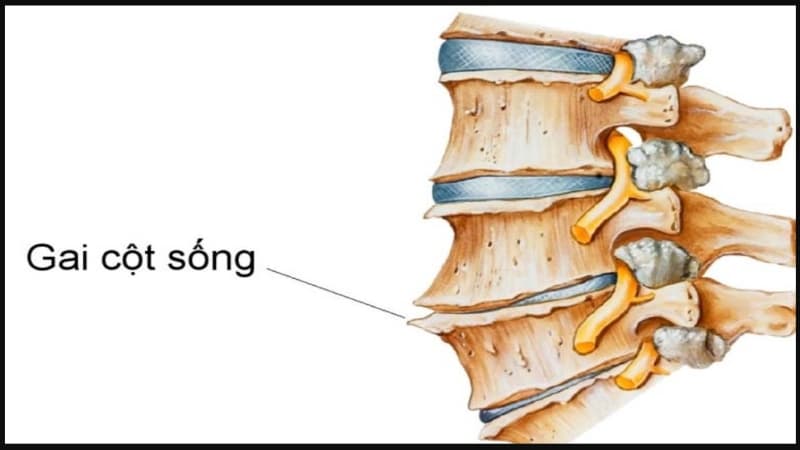 Gai đốt sống cổ là bệnh gì, có thể điều trị được không?