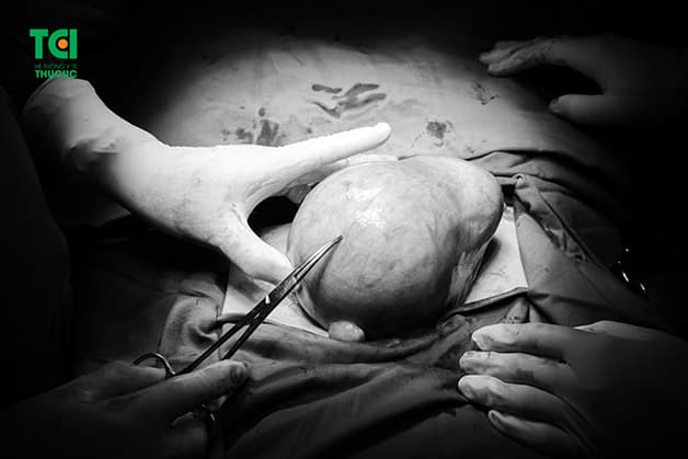 Khối u có kích thước lớn dễ dẫn tới nhiều biến chứng có hại cho sức khỏe