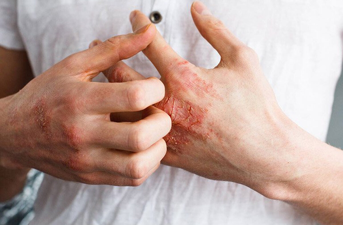 Các triệu chứng bệnh giang mai ở giai đoạn 2 là vết ban nổi từ thân sau đó từ từ lan ra toàn bộ cơ thể