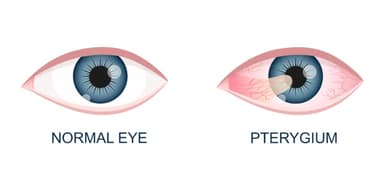 Dấu hiệu bệnh mộng thịt và cách điều trị hiệu quả