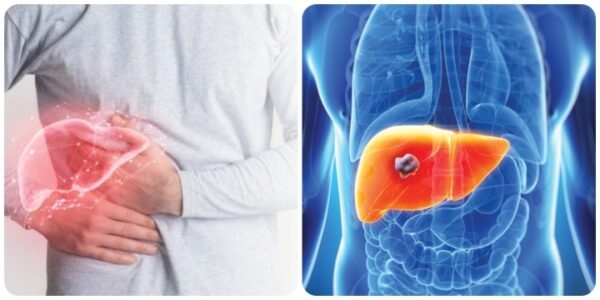 dấu hiệu ung thư gan phổ biến