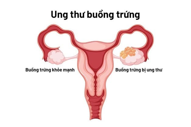 sàng lọc ung thư buồng trứng