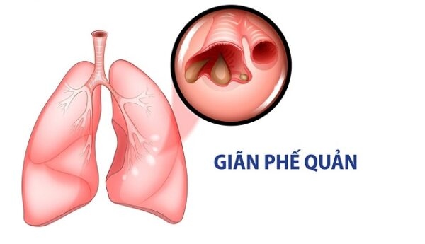 Nguyên nhân dẫn đến giãn phế quản có thể do bẩm sinh hoặc mắc phải
