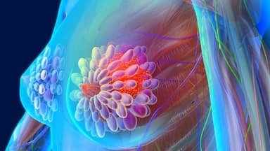 Phương pháp chẩn đoán hình ảnh trong tầm soát ung thư tuyến vú