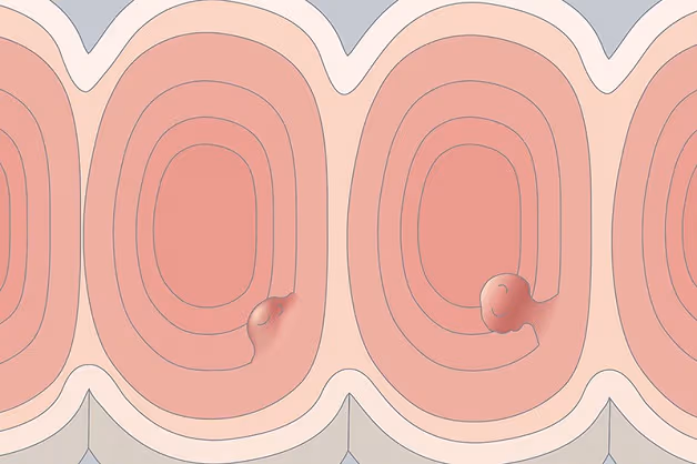 polyp đại trực tràng lớn có nguy cơ gây ung thư