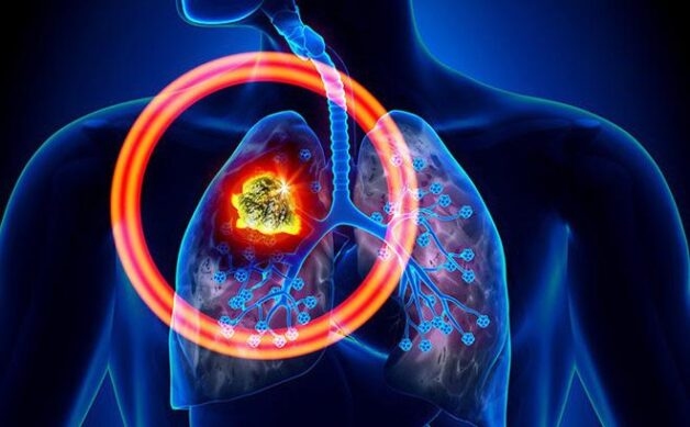 Ung thư phổi là căn bệnh ác tính và nguy hiểm đến tính mạng của người bệnh