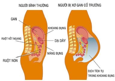 Xơ gan cổ trướng chẩn đoán dựa vào đâu?