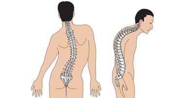 Nhận biết những dấu hiệu của thoái hóa đốt sống lưng