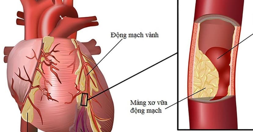 Cảnh báo các dấu hiệu của bệnh đột quỵ tim