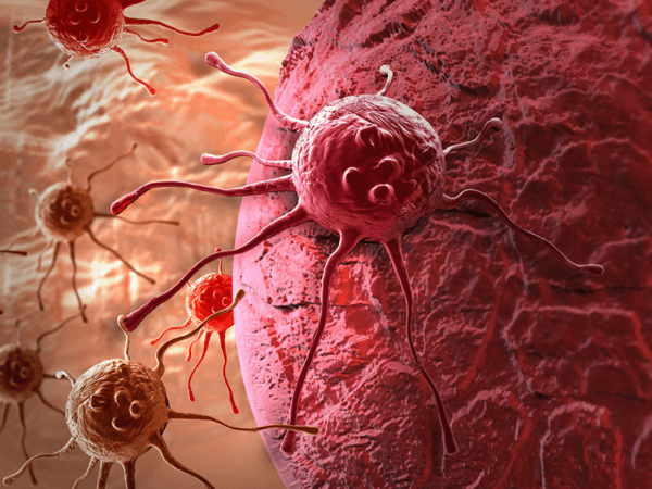 ung thư buồng trứng di căn thế nào