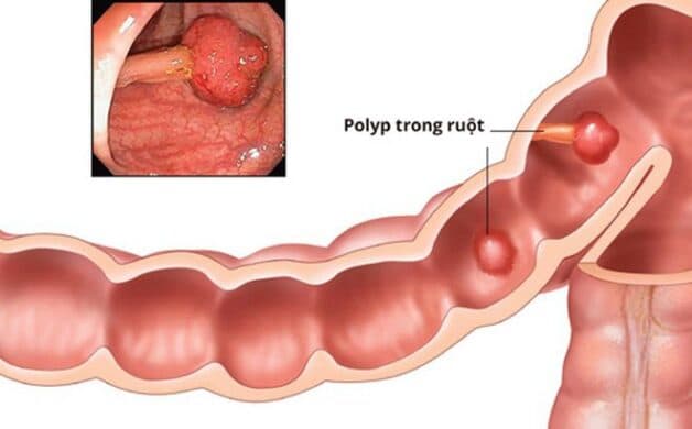 Hình ảnh polyp đại tràng nghịch sản nhẹ