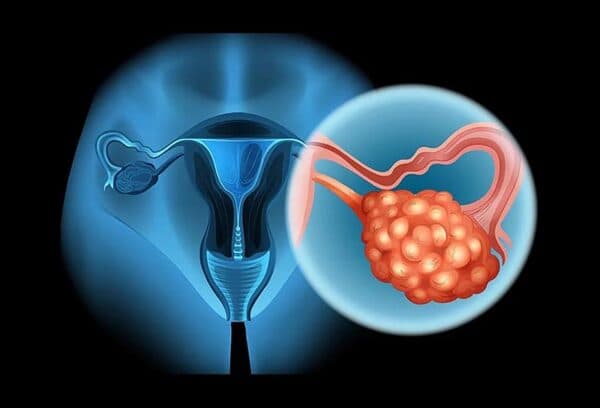 Ung thư buồng trứng di căn