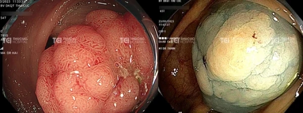 Polyp đại tràng nghịch sản nặng