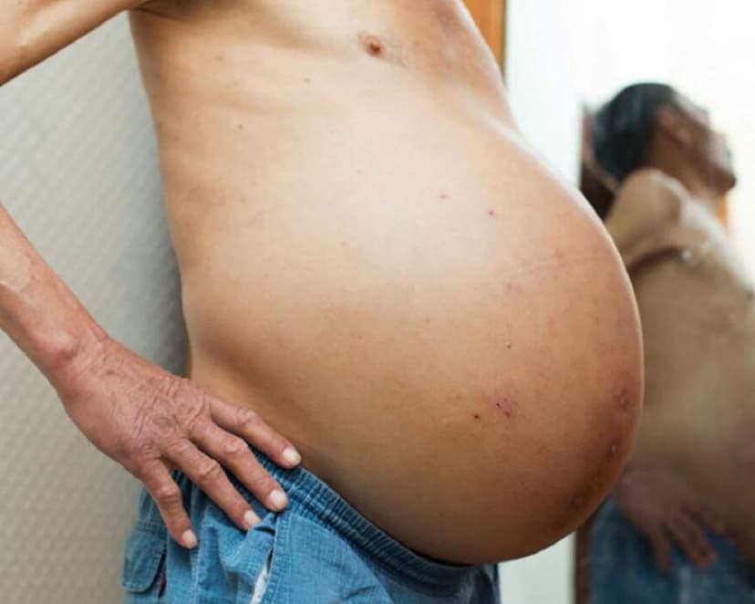 Tiếp xúc với người bệnh xơ gan cổ trướng có lây không?