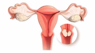 Các bước khám trong quy trình tầm soát ung thư cổ tử cung