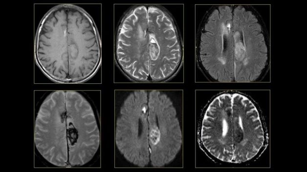 Chụp MRI não giúp bác sĩ phát hiện và chẩn đoán một số bệnh lý