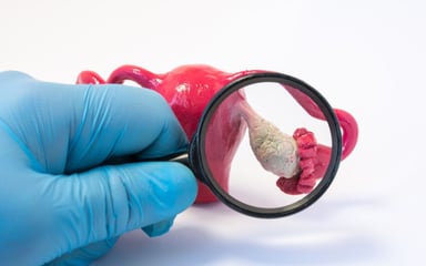 Phân biệt đa nang buồng trứng và u nang buồng trứng