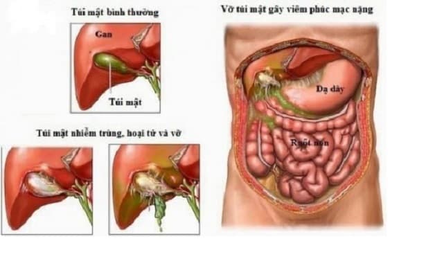 Điều trị dấu hiệu viêm ruột thừa cấp