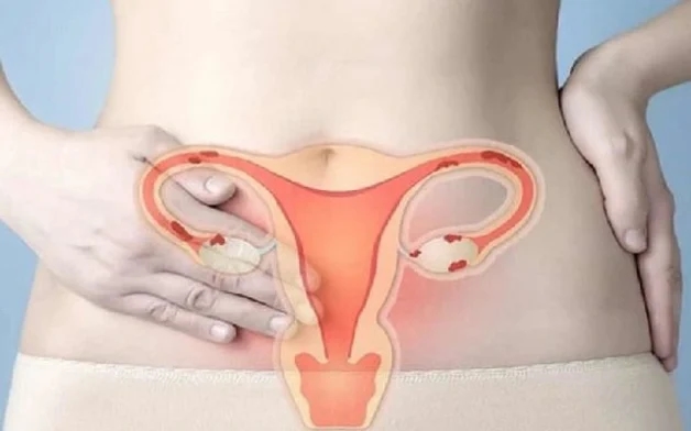 Ung thư buồng trứng diễn biến ở giai đoạn 3 và cách điều trị