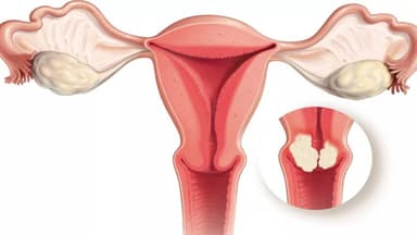 Làm thế nào để chữa ung thư cổ tử cung?