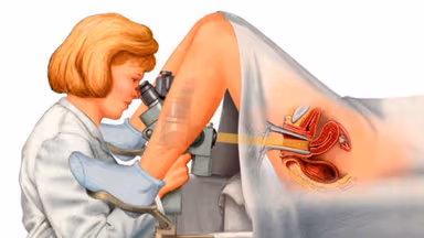 Kết quả soi cổ tử cung bất thường là như thế nào?