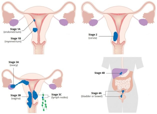 Tìm hiểu bệnh ung thư buồng trứng giai đoạn di căn ổ bụng