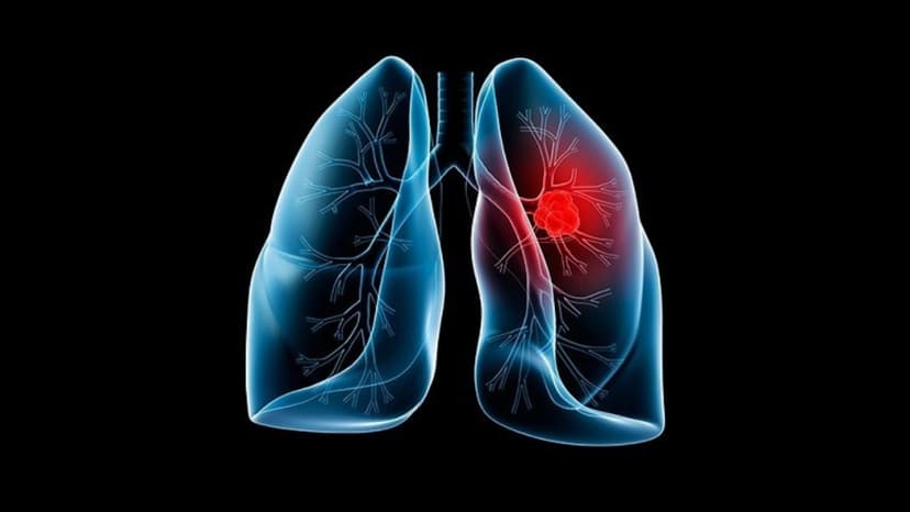 Tìm hiểu chỉ số xét nghiệm ung thư phổi CYFRA 21-1