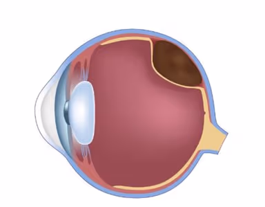 Một số triệu chứng bong võng mạc mắt điển hình là gì?
