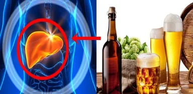Viêm gan cấp do rượu: Phòng ngừa và điều trị